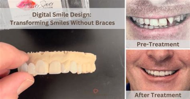 Affordable Denture Implants: Transforming Smiles Without Breaking the Bank