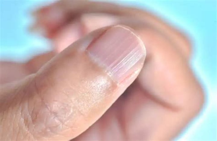 Delve into the Mystery of Vertical Nail Lines: Causes and Implications