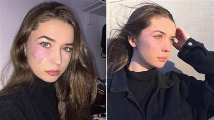 Does Oliver Stark Have a Birthmark on His Face? Uncovering the Truth