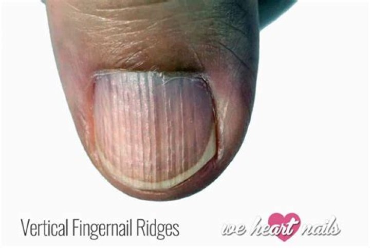Vertical Lines on Nails: Causes and Treatment