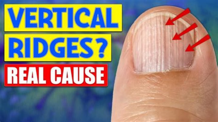 What Do Ridges and Vertical Lines on Fingernails Mean?